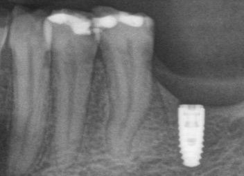 Implantat 