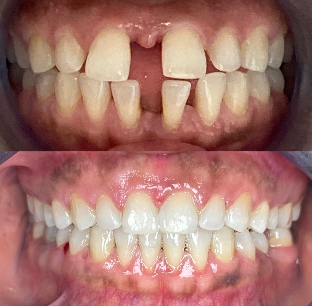 Invisalign