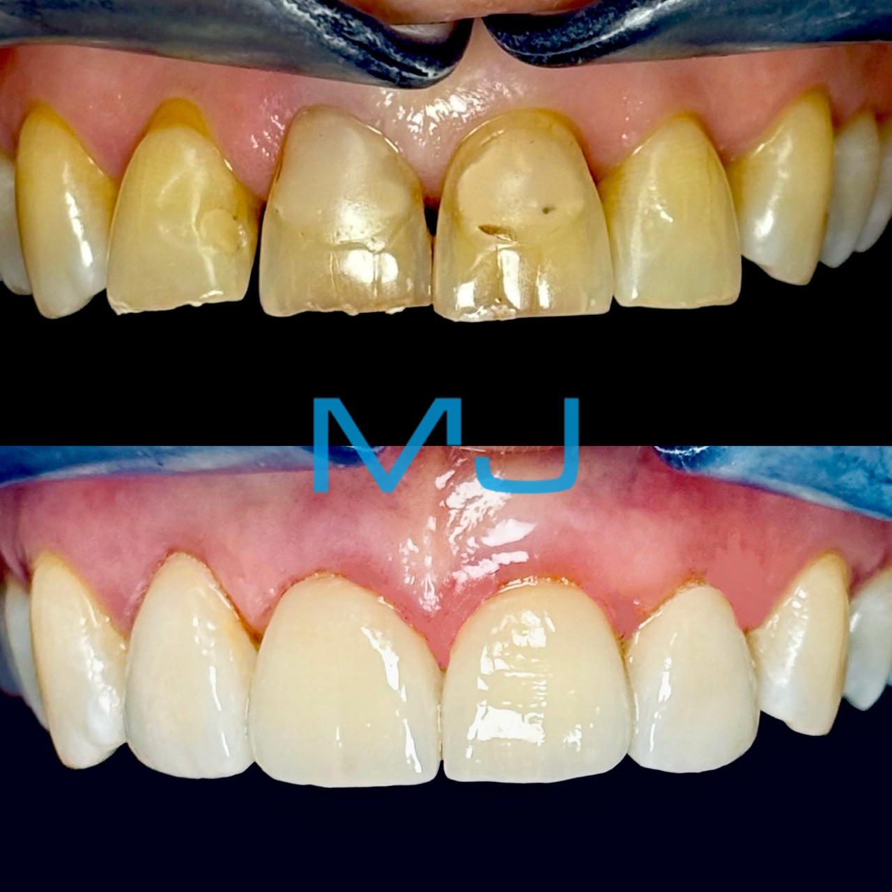 dental crowns